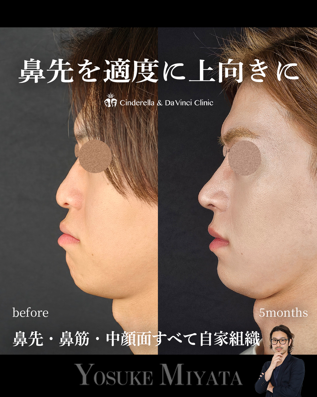 鼻先の角度を上にの画像