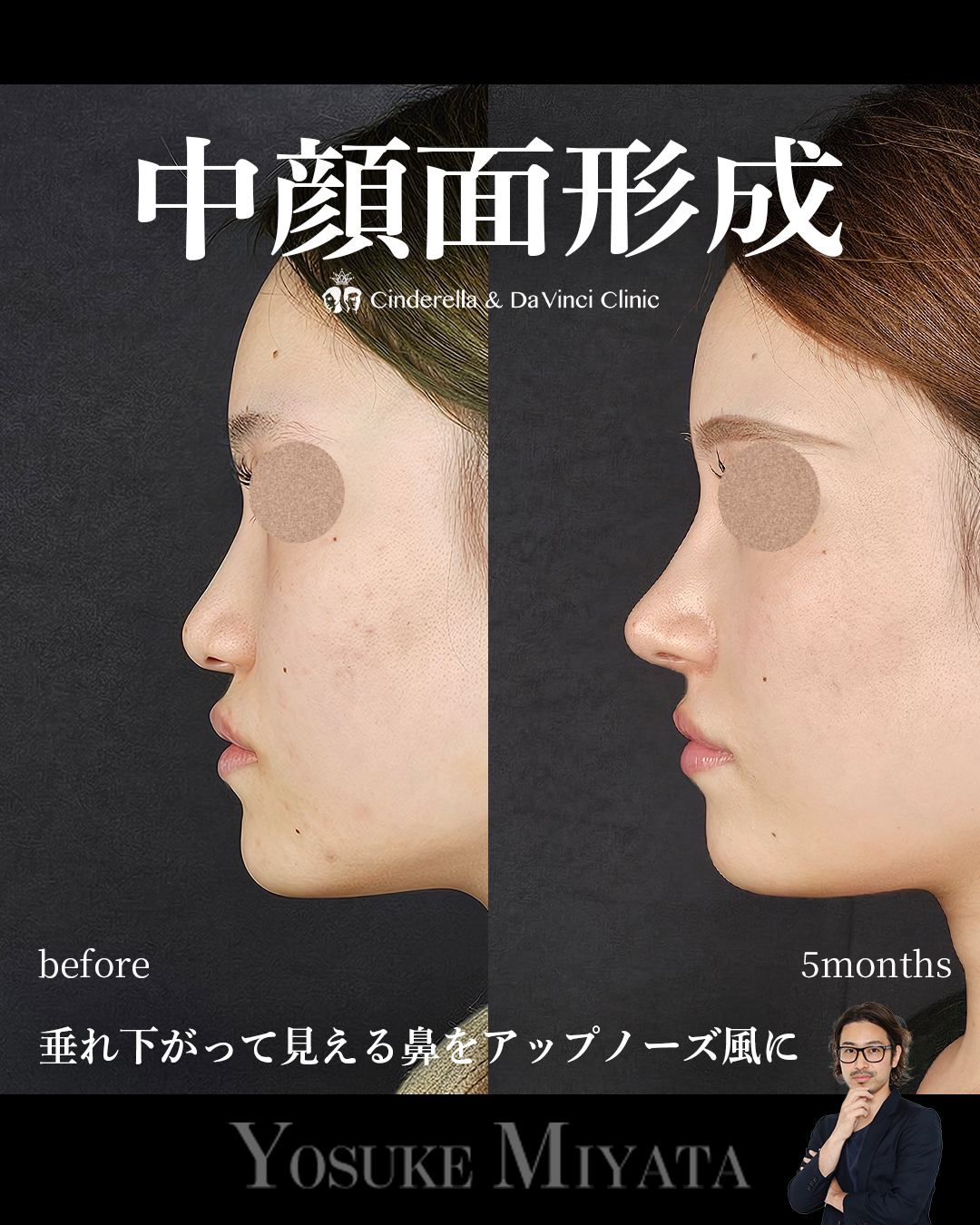 中顔面形成の画像
