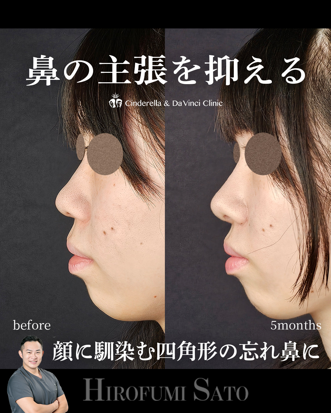 鼻の主張を抑えるの画像