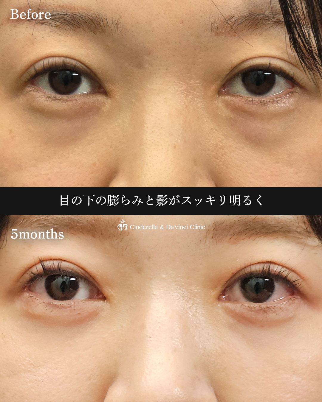 クマ取り(裏ハムラ法)の画像