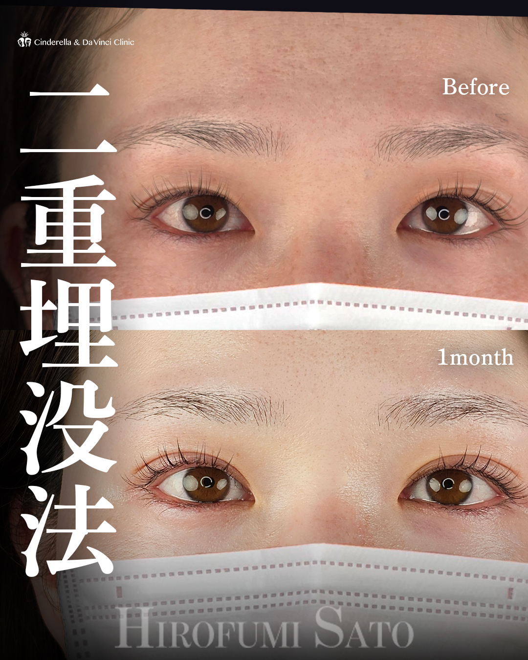 左右差の無い二重