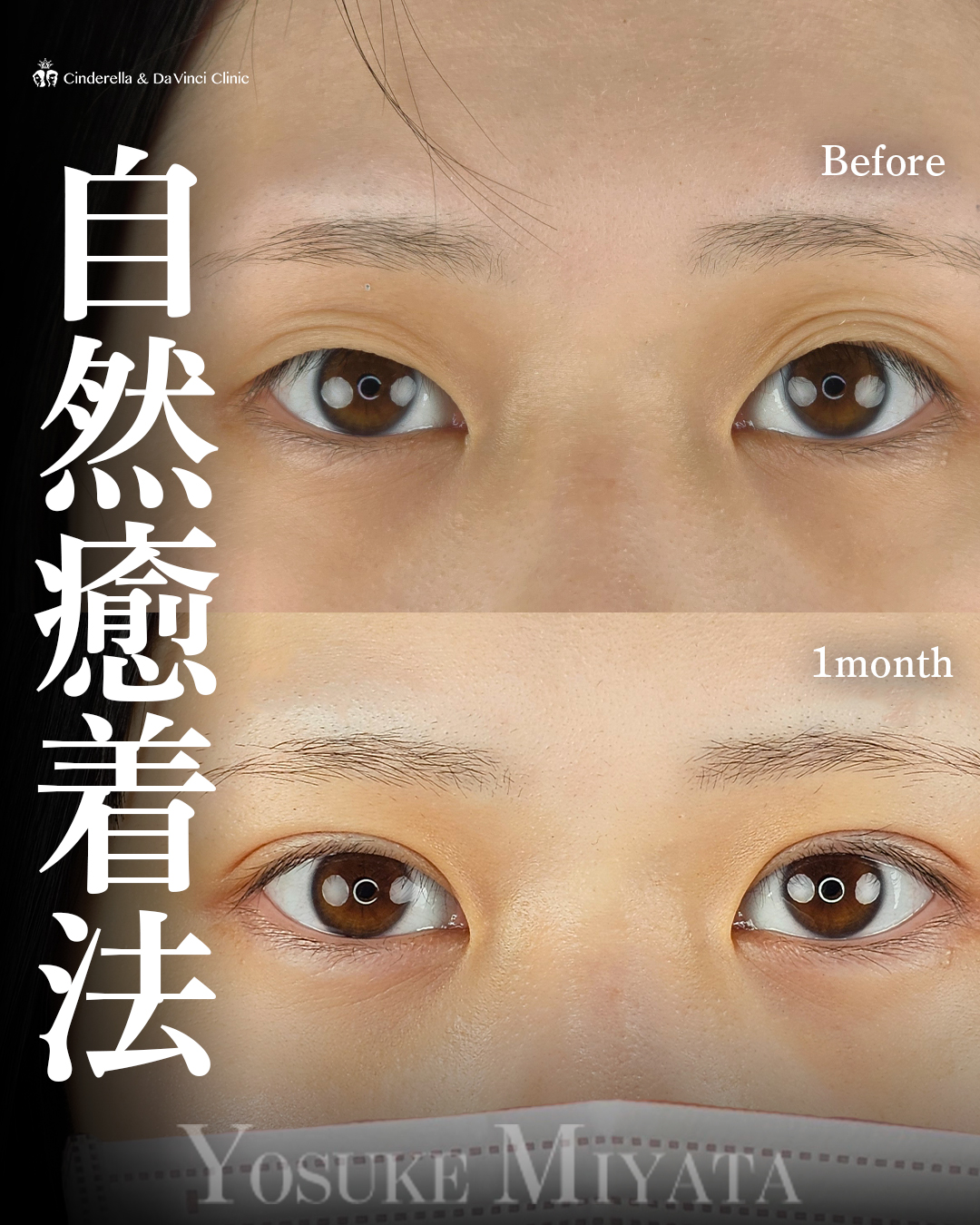 ナチュラル盛れ二重