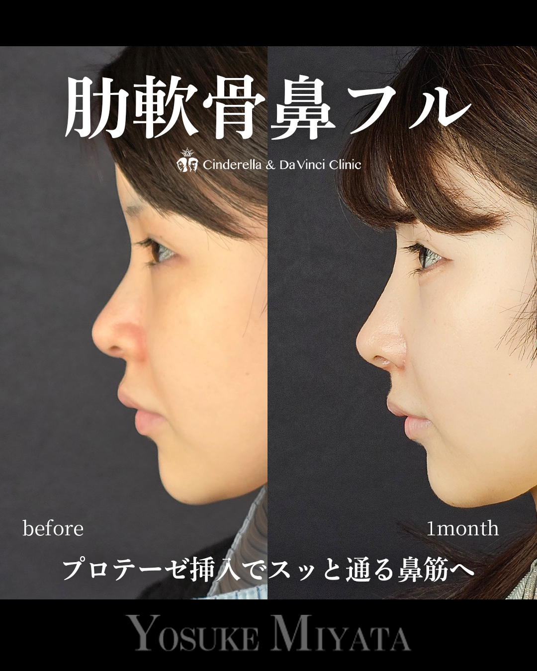 忘れ鼻をつくるの画像