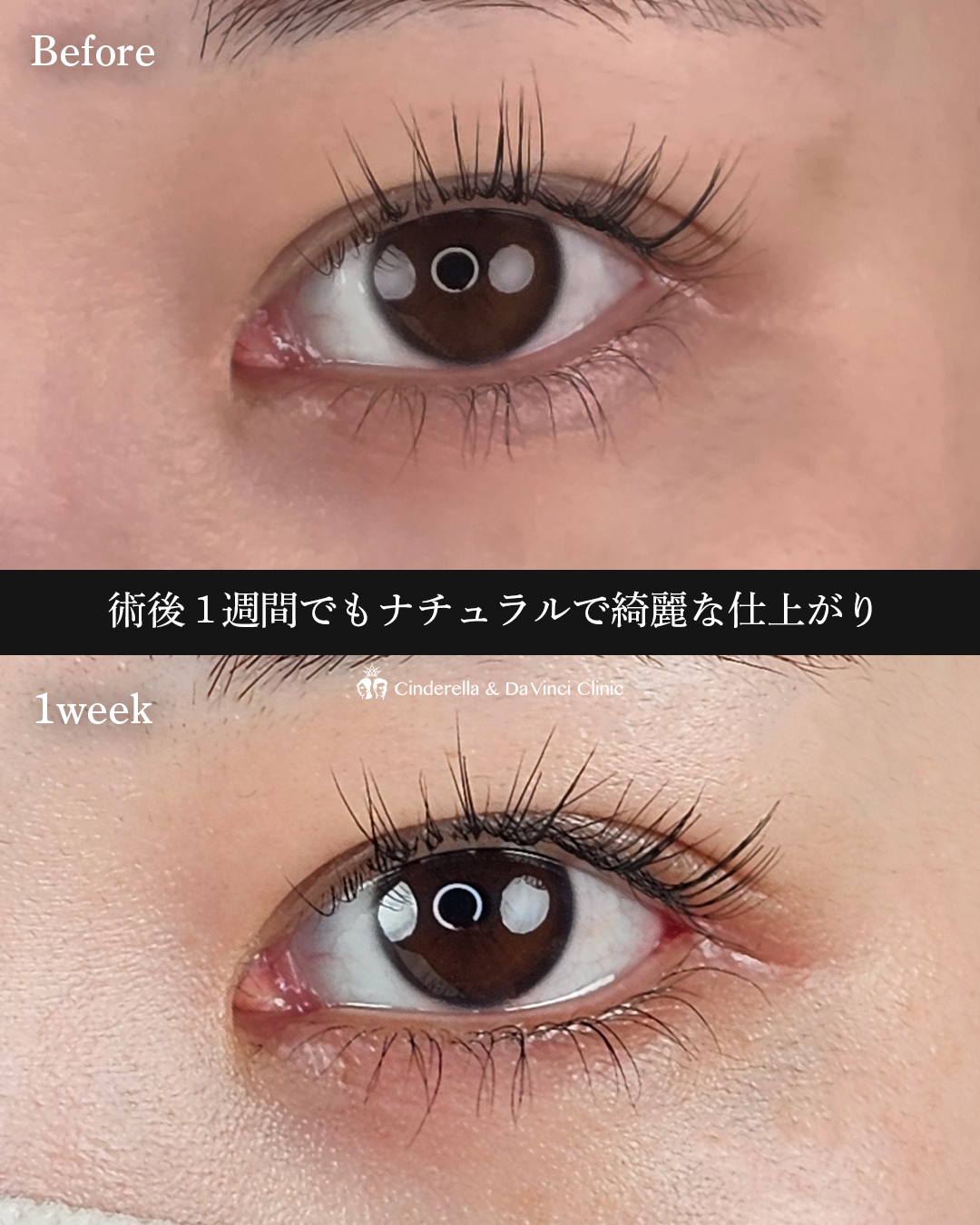 術後1週間の画像