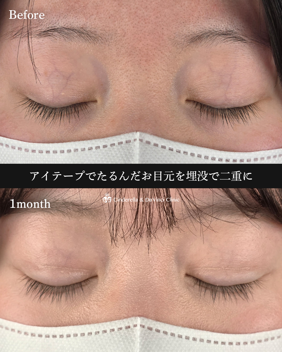 埋没でパッチリの画像