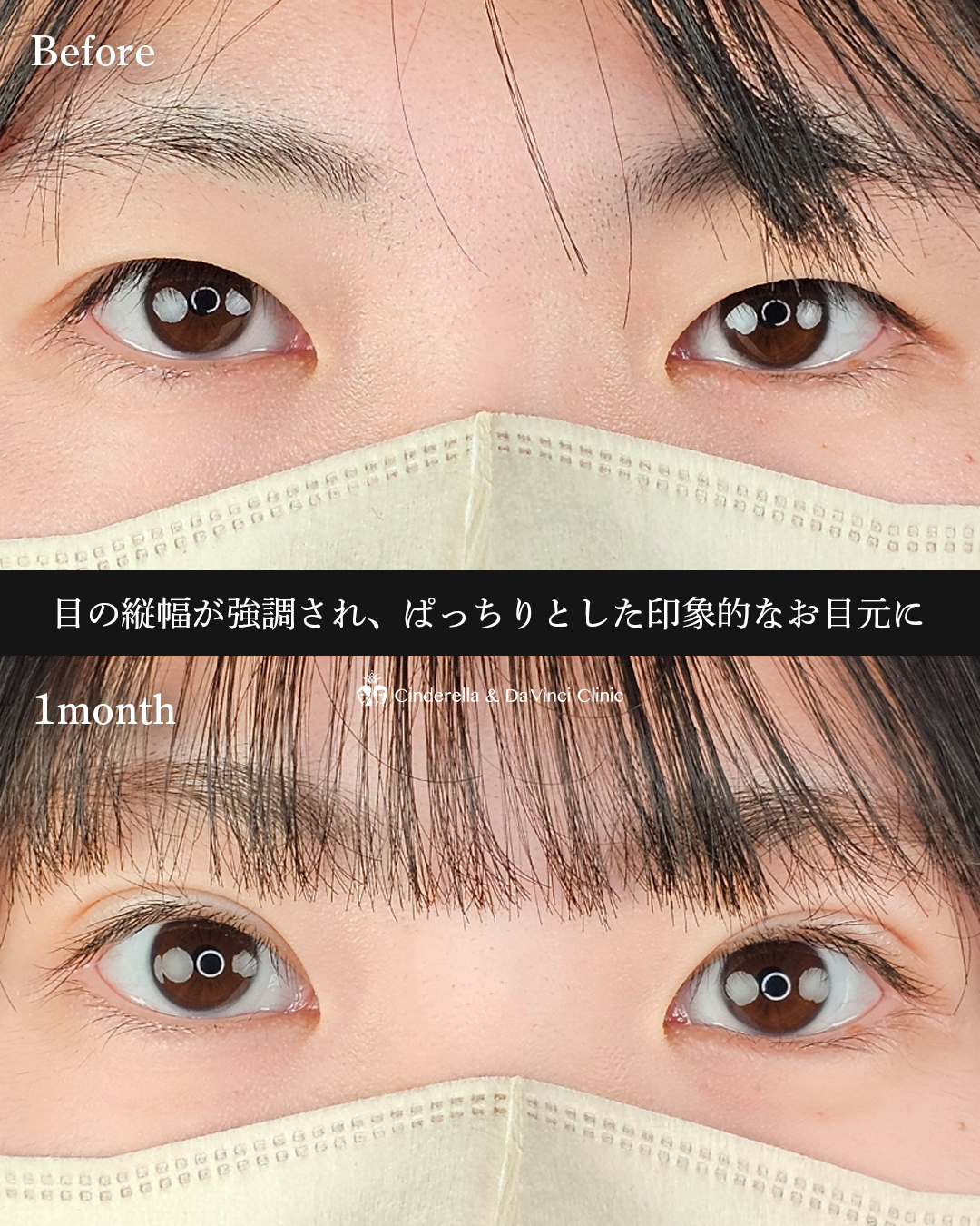 可愛らしいぱっちり二重の画像