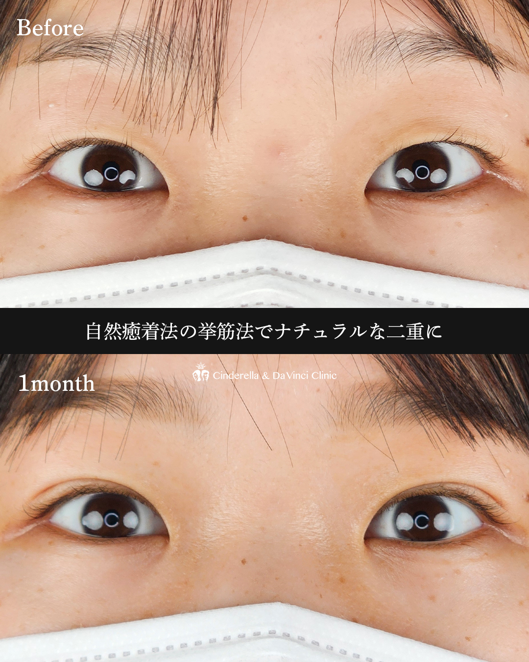 自然な二重にの画像