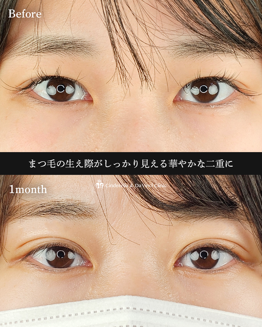 埋没で華やかな二重にの画像