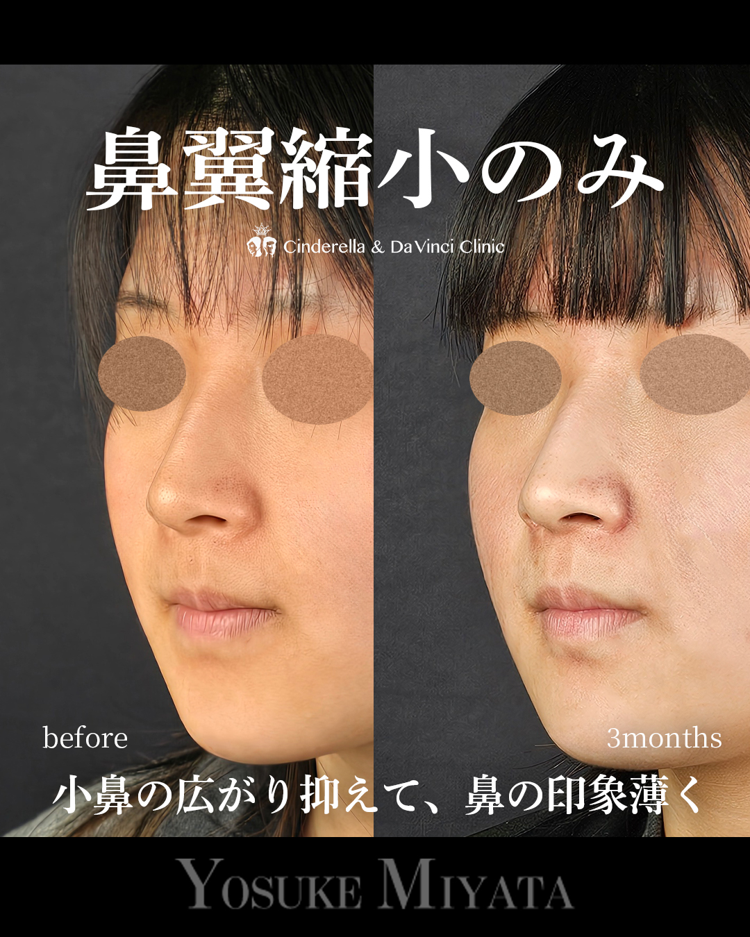 鼻翼縮小のみの画像
