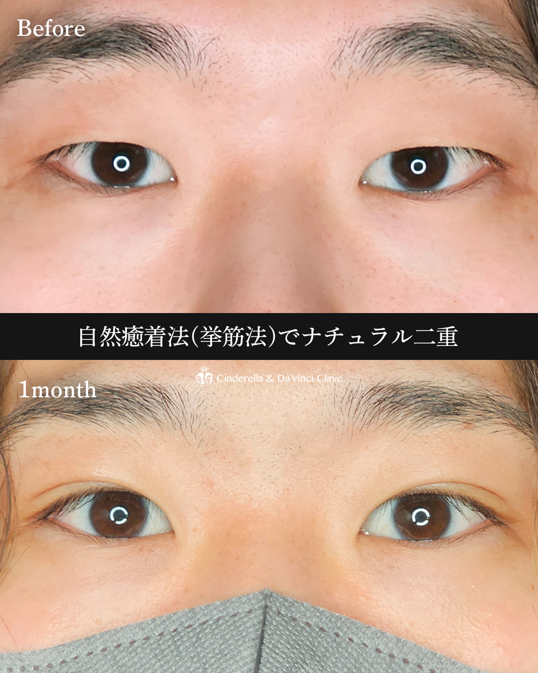 男性の自然な二重の画像