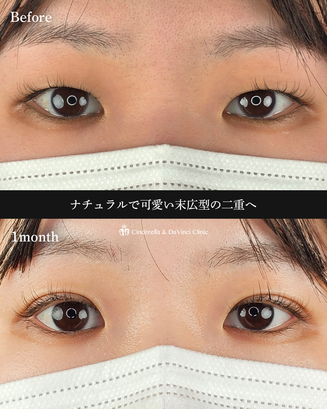 自然な末広二重にの画像