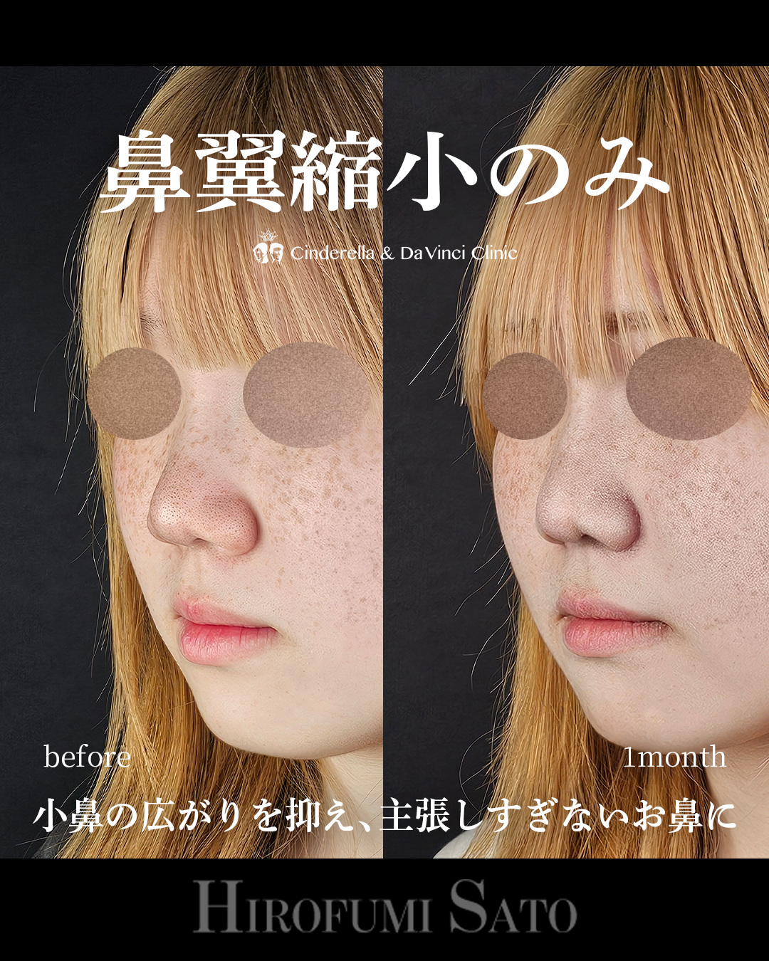 鼻翼縮小のみの画像