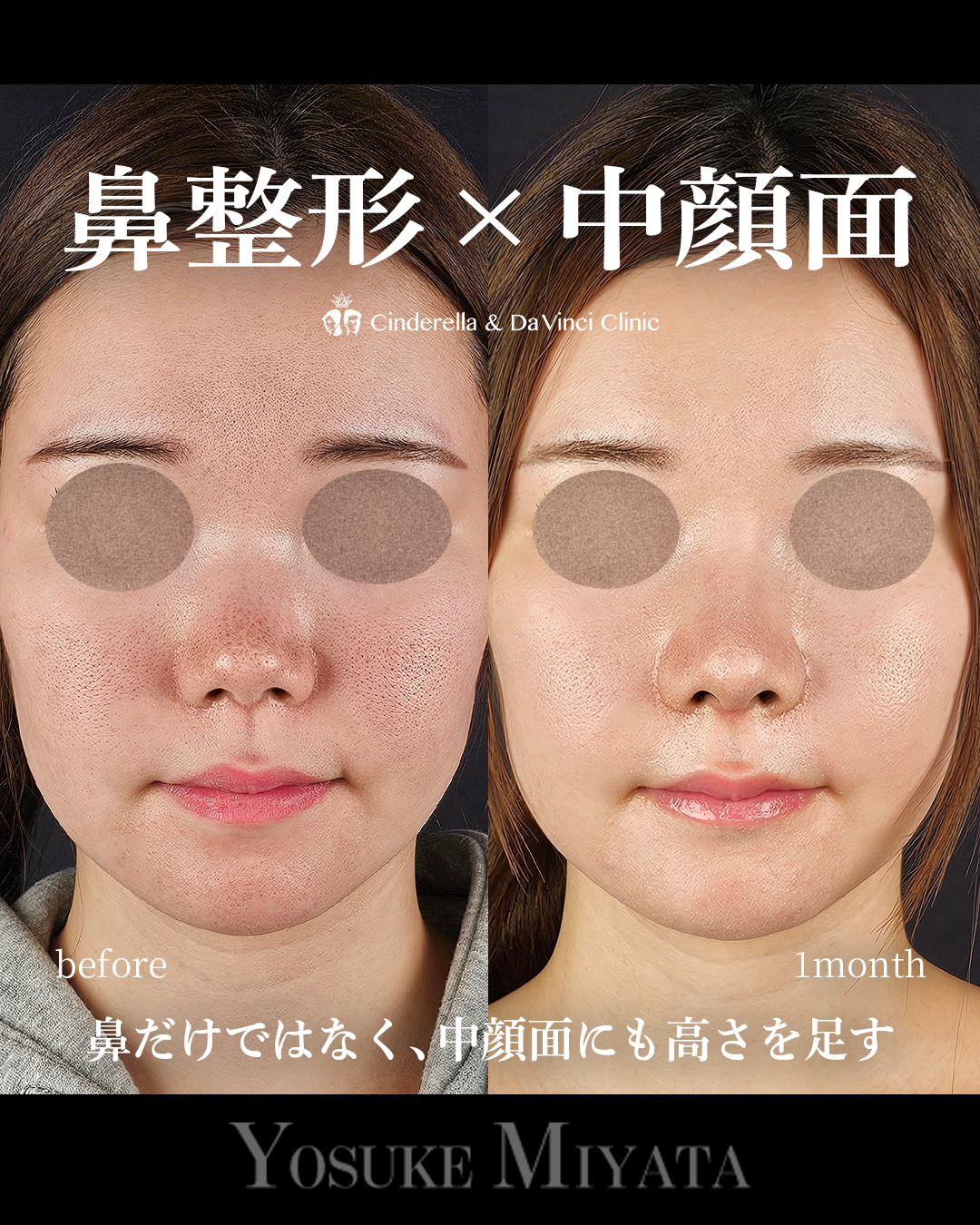 鼻整形×中顔面の画像