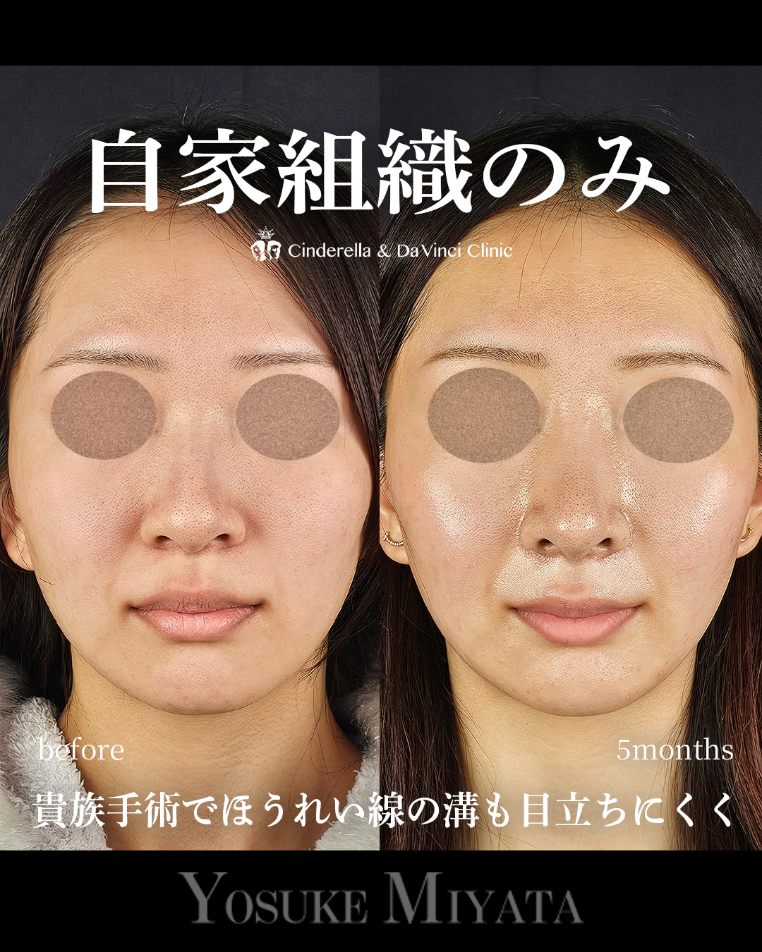 鼻先の丸みを軽減の画像