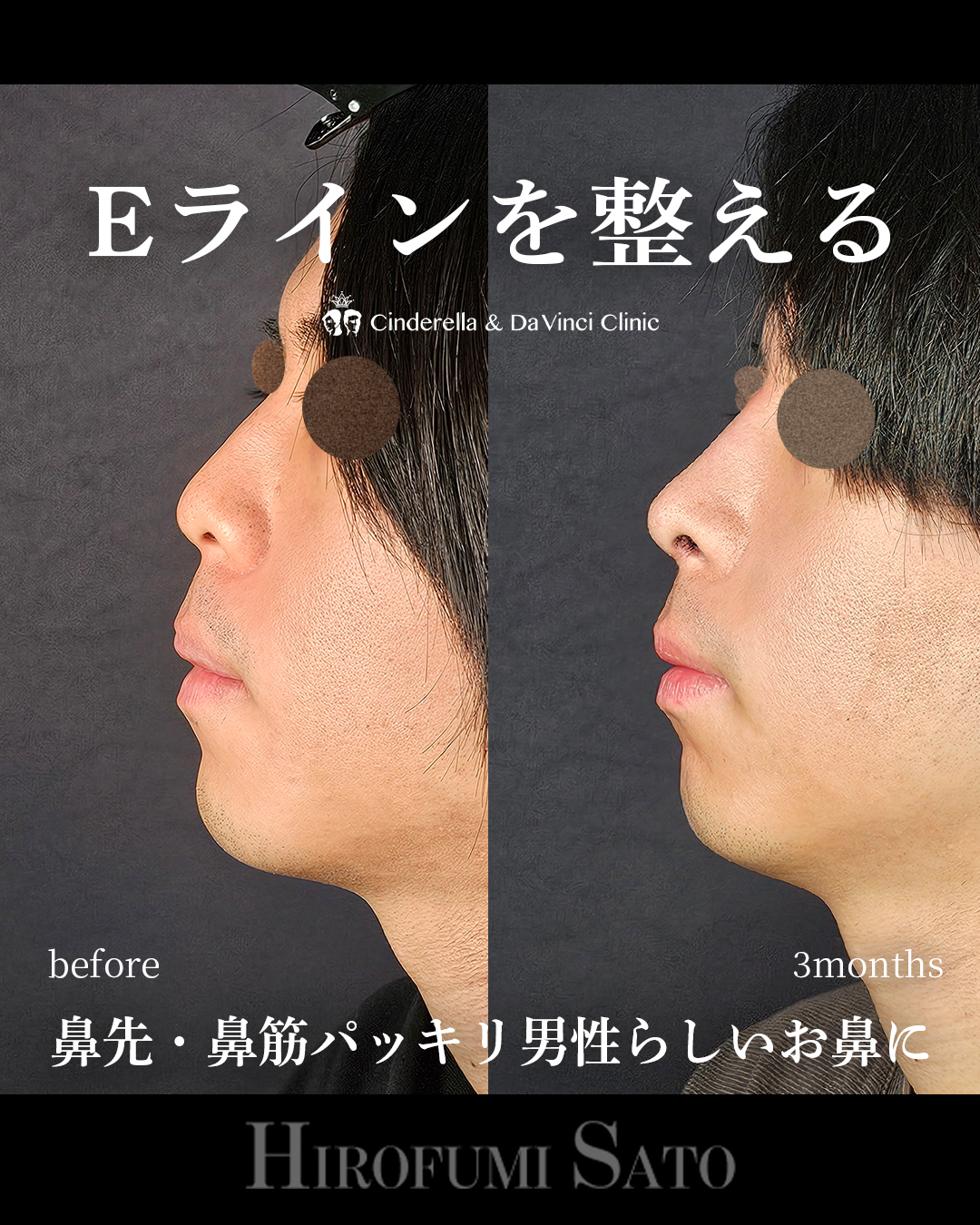 男性の鼻整形の画像