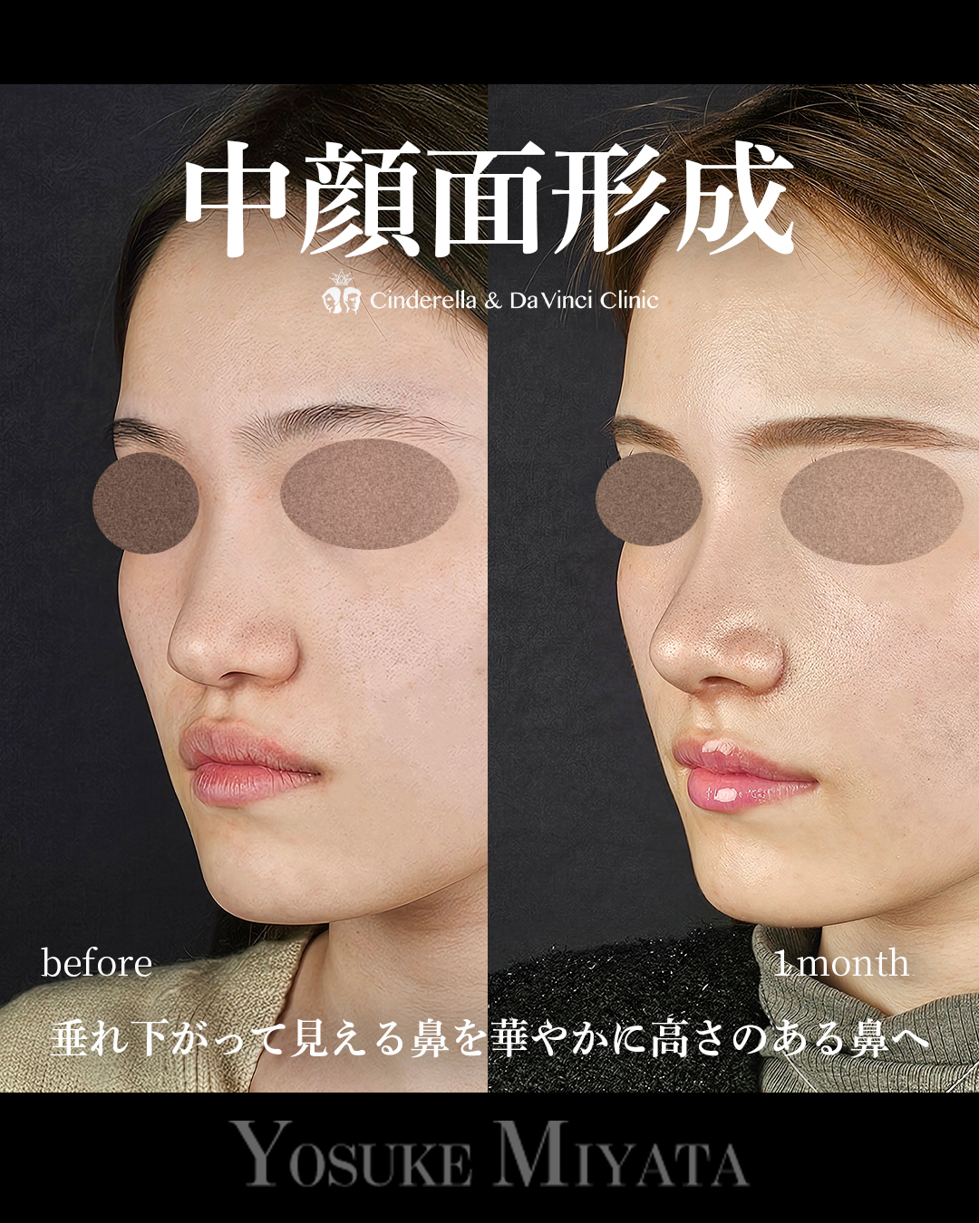 中顔面形成の画像