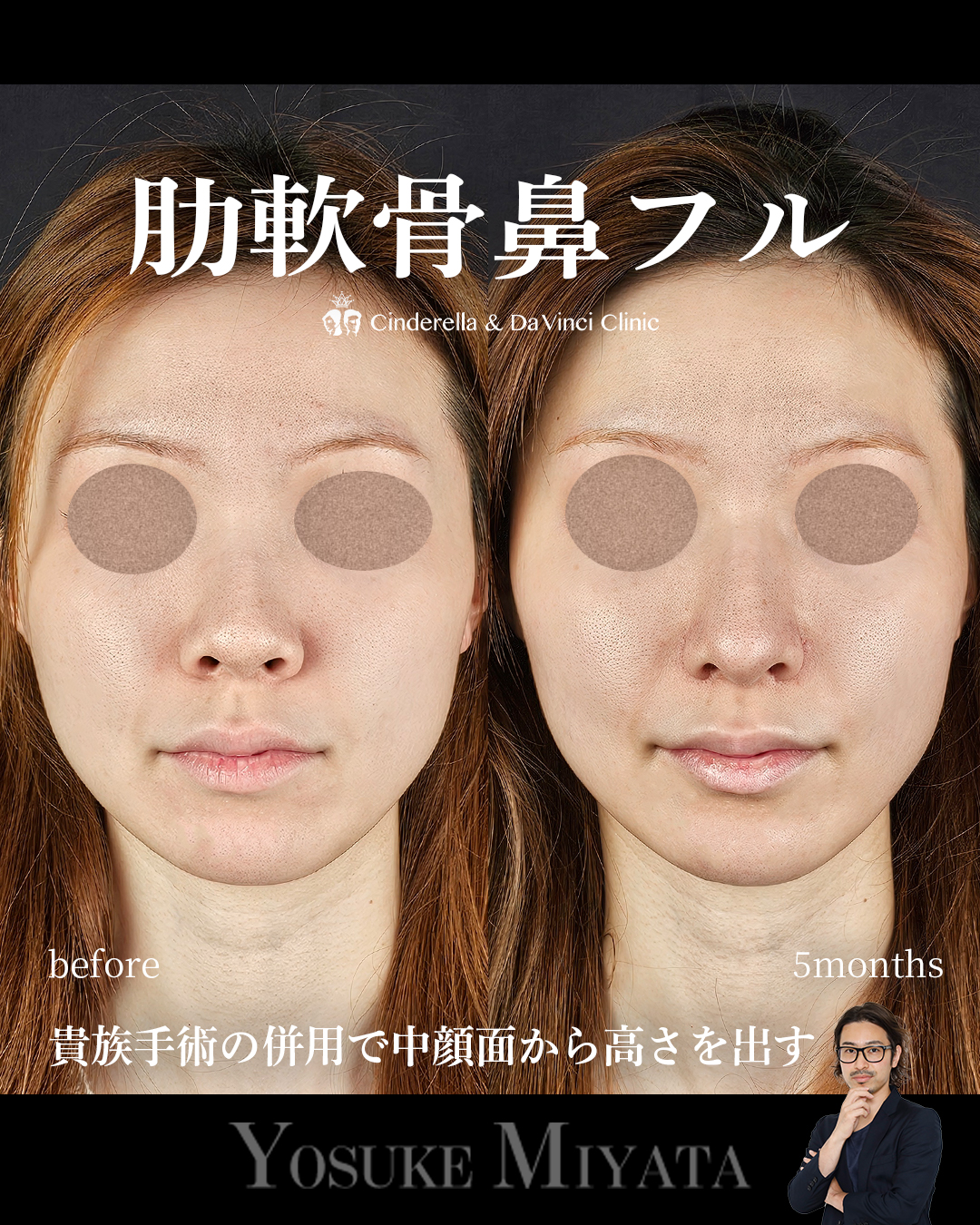 バランスの良い鼻の画像
