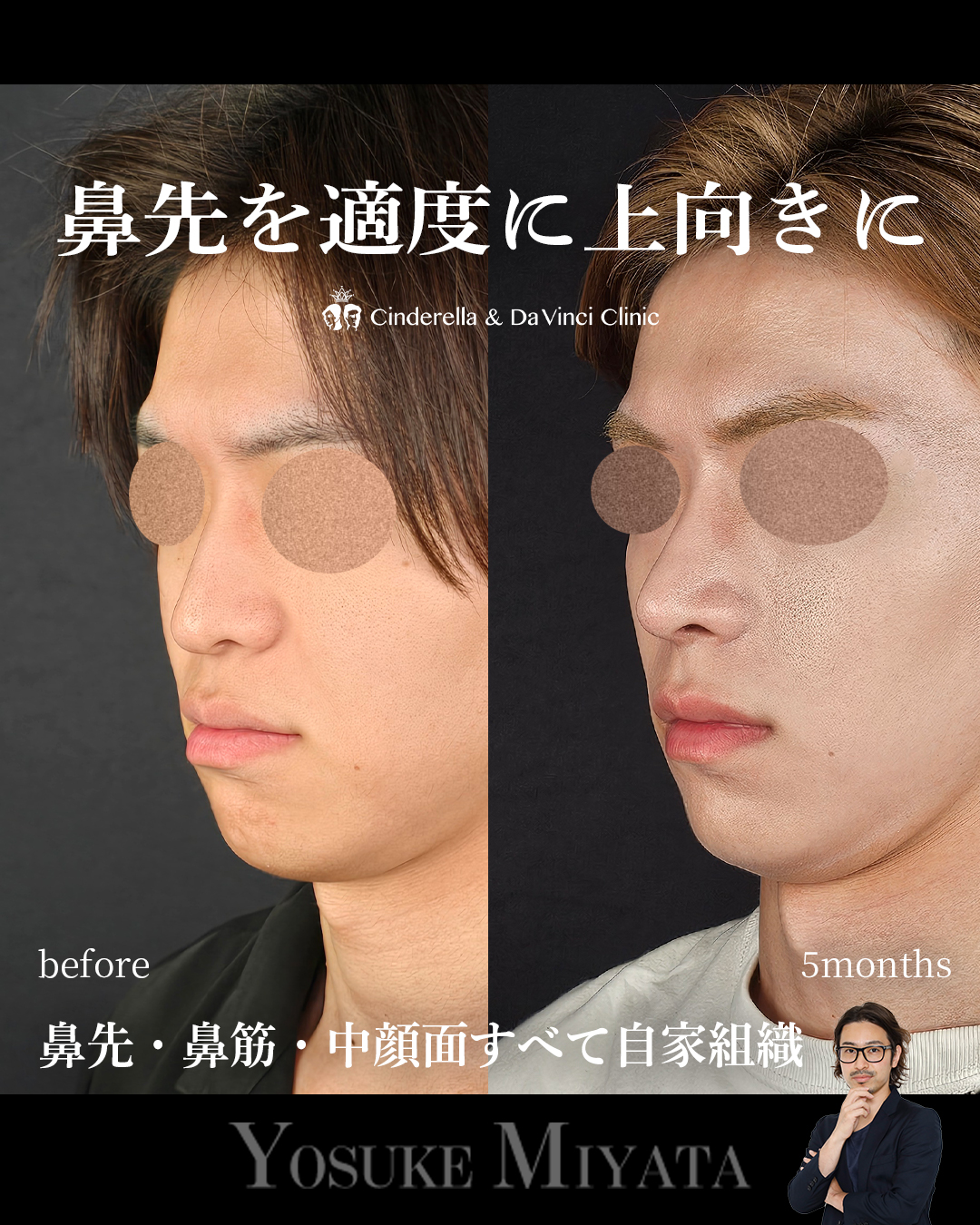 鼻先の角度を上にの画像