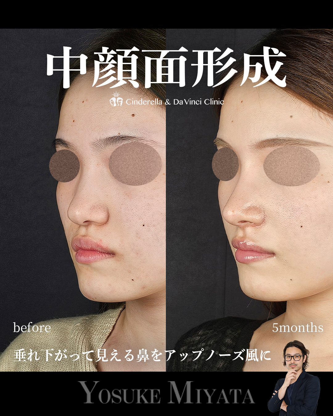 中顔面形成の画像
