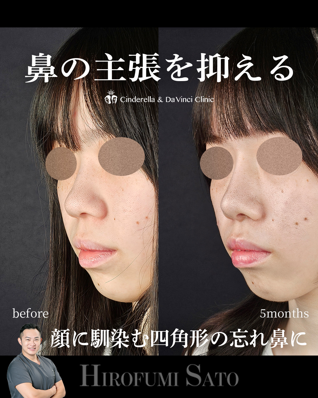 鼻の主張を抑えるの画像