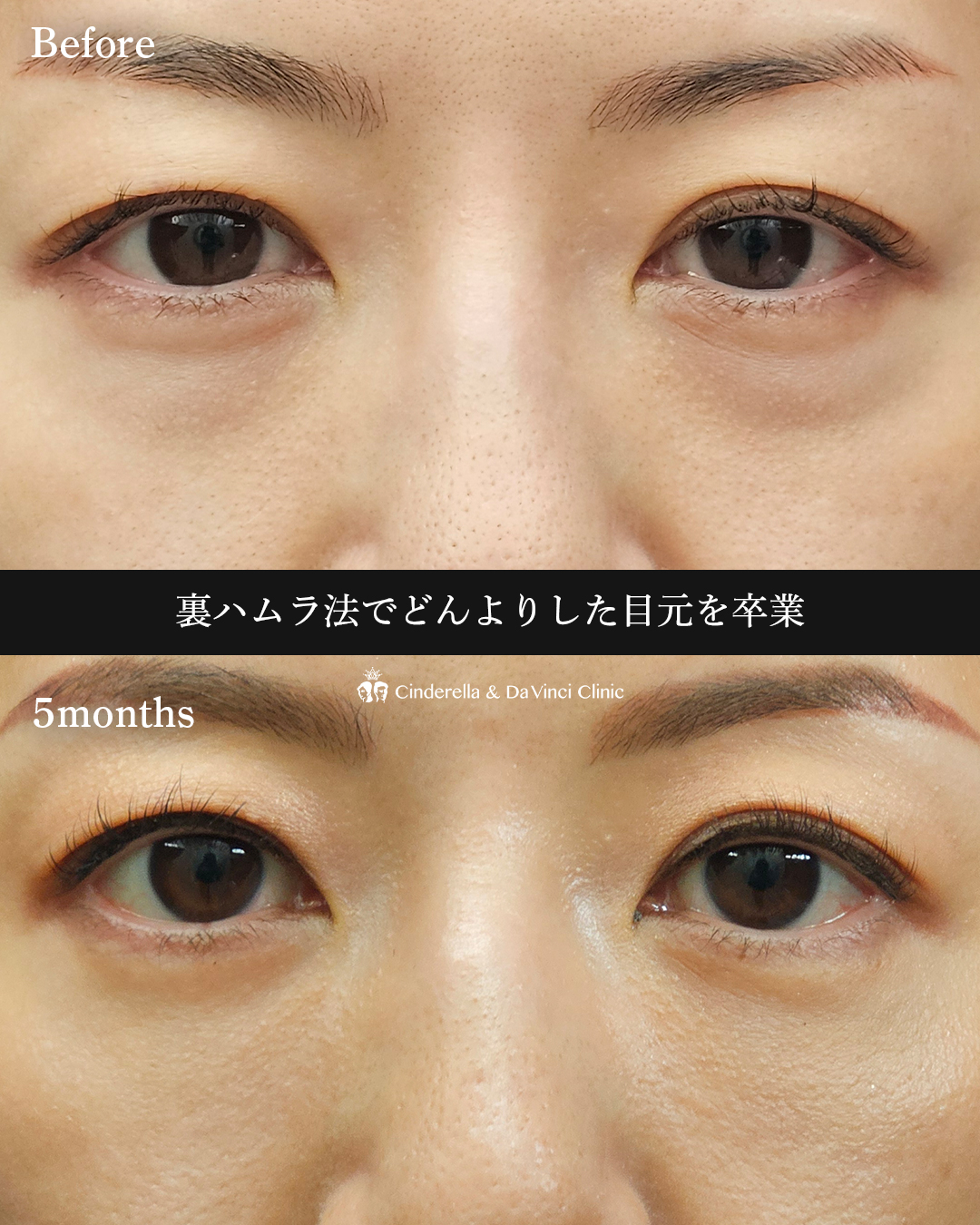 目の下若返りの画像