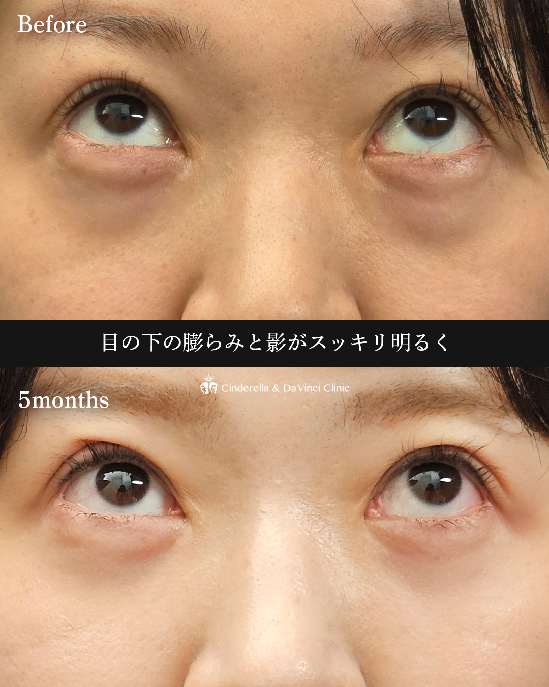 クマ取り(裏ハムラ法)の画像