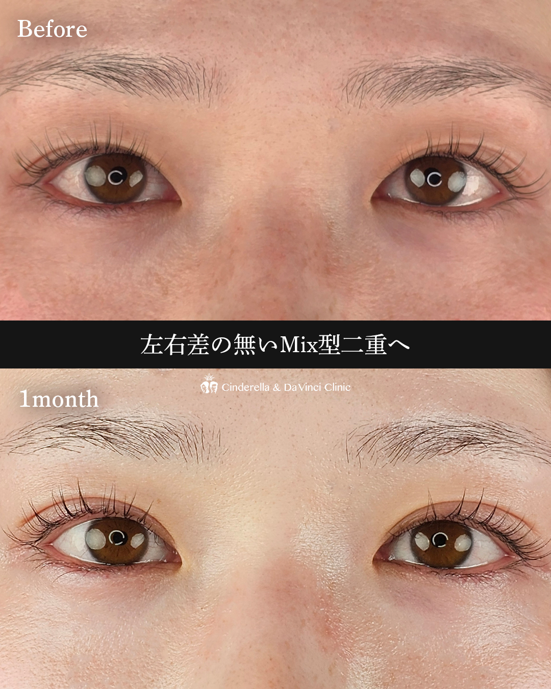 左右差の無い二重の画像