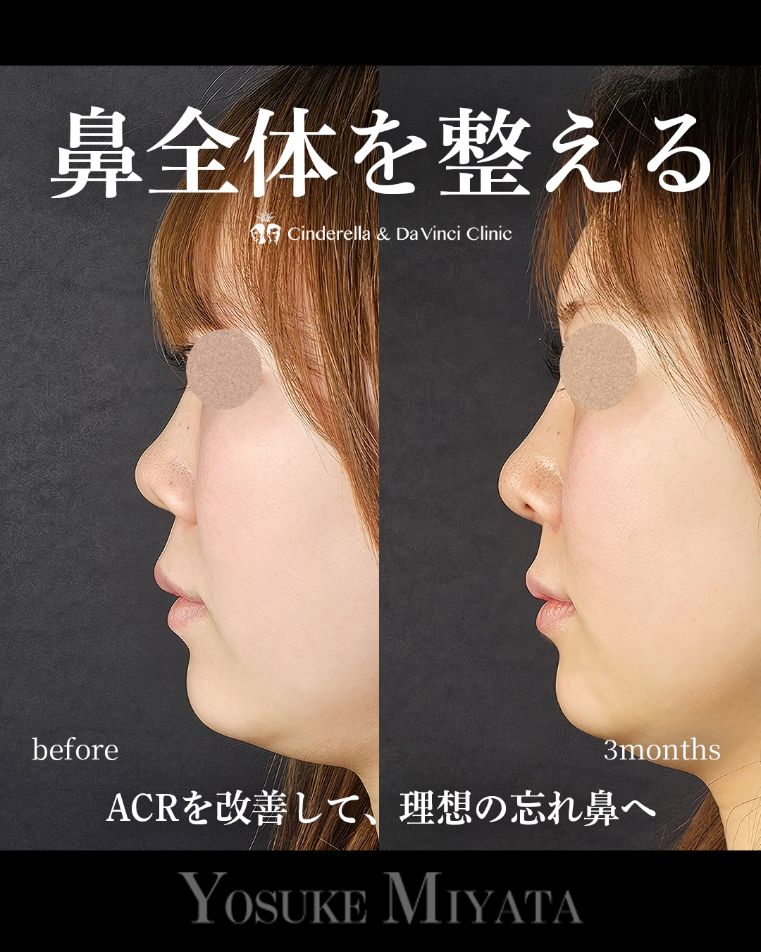 鼻全体を整えるの画像