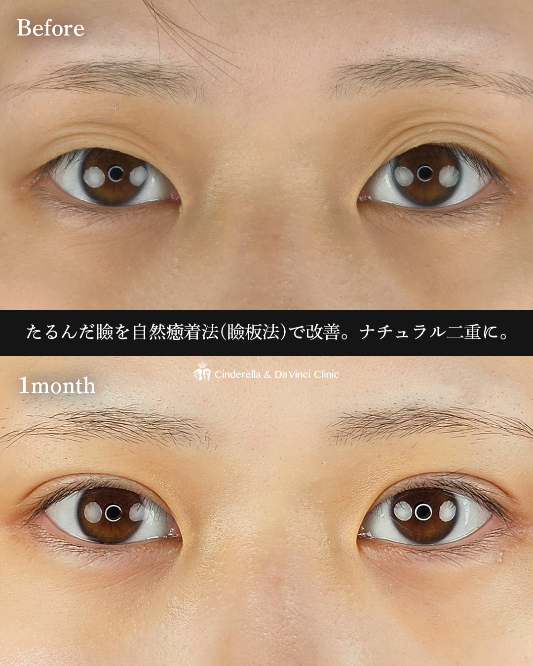 ナチュラル盛れ二重の画像