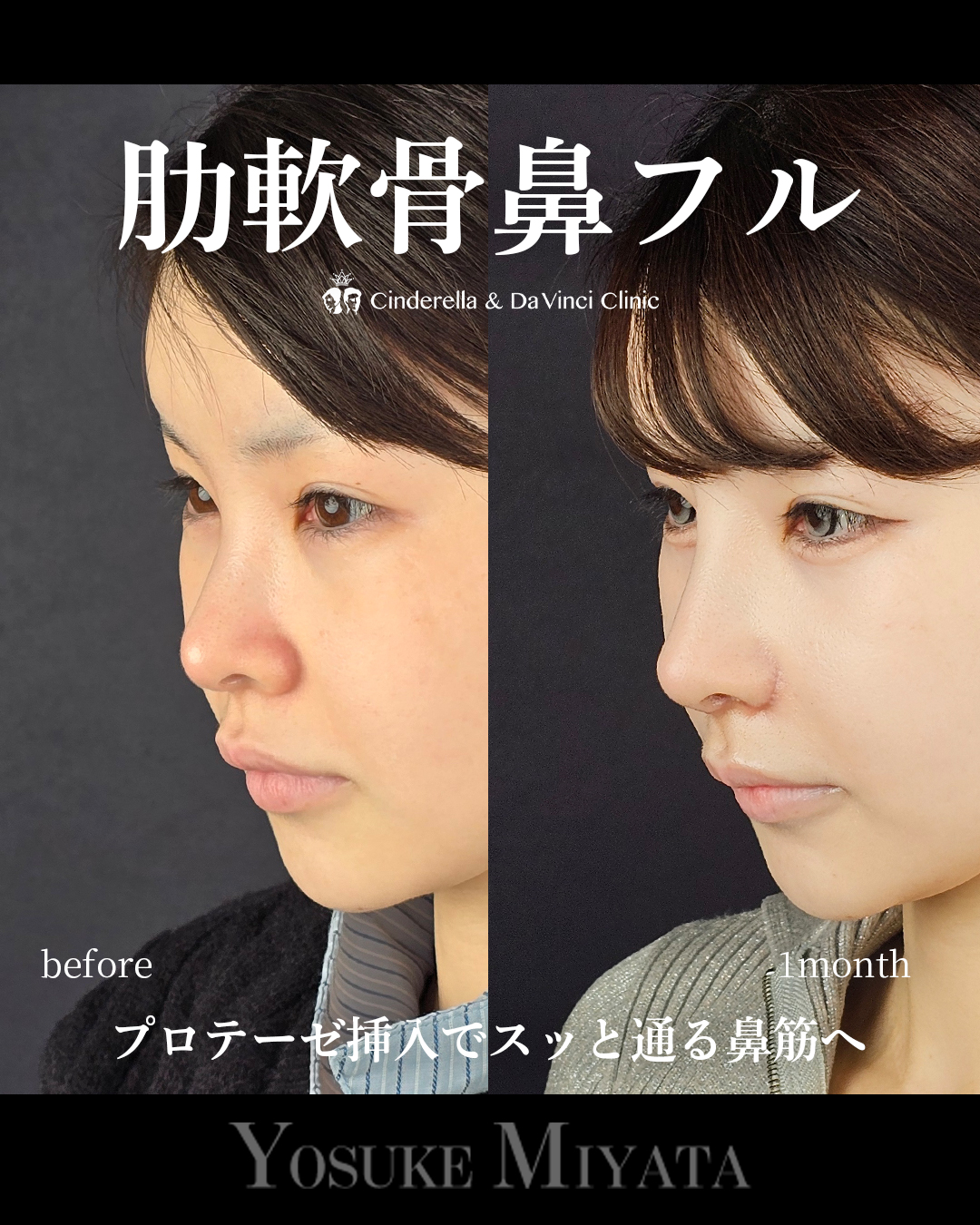 忘れ鼻をつくるの画像