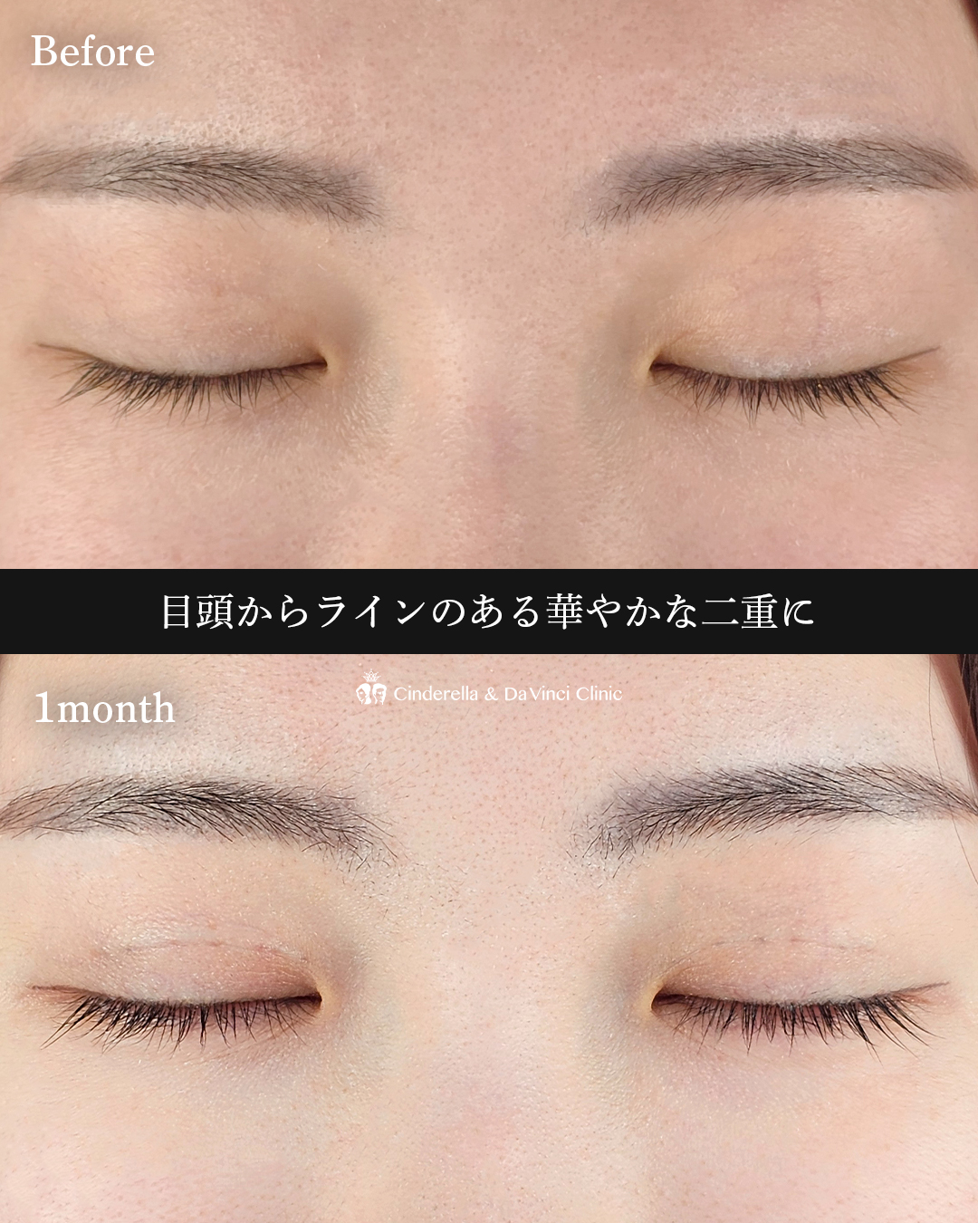 華やか二重の画像