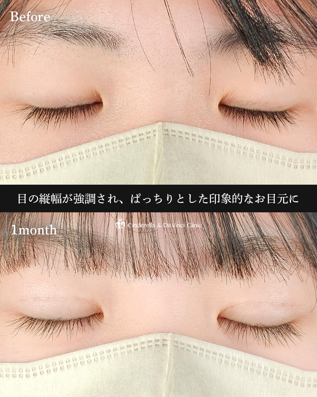 可愛らしいぱっちり二重の画像