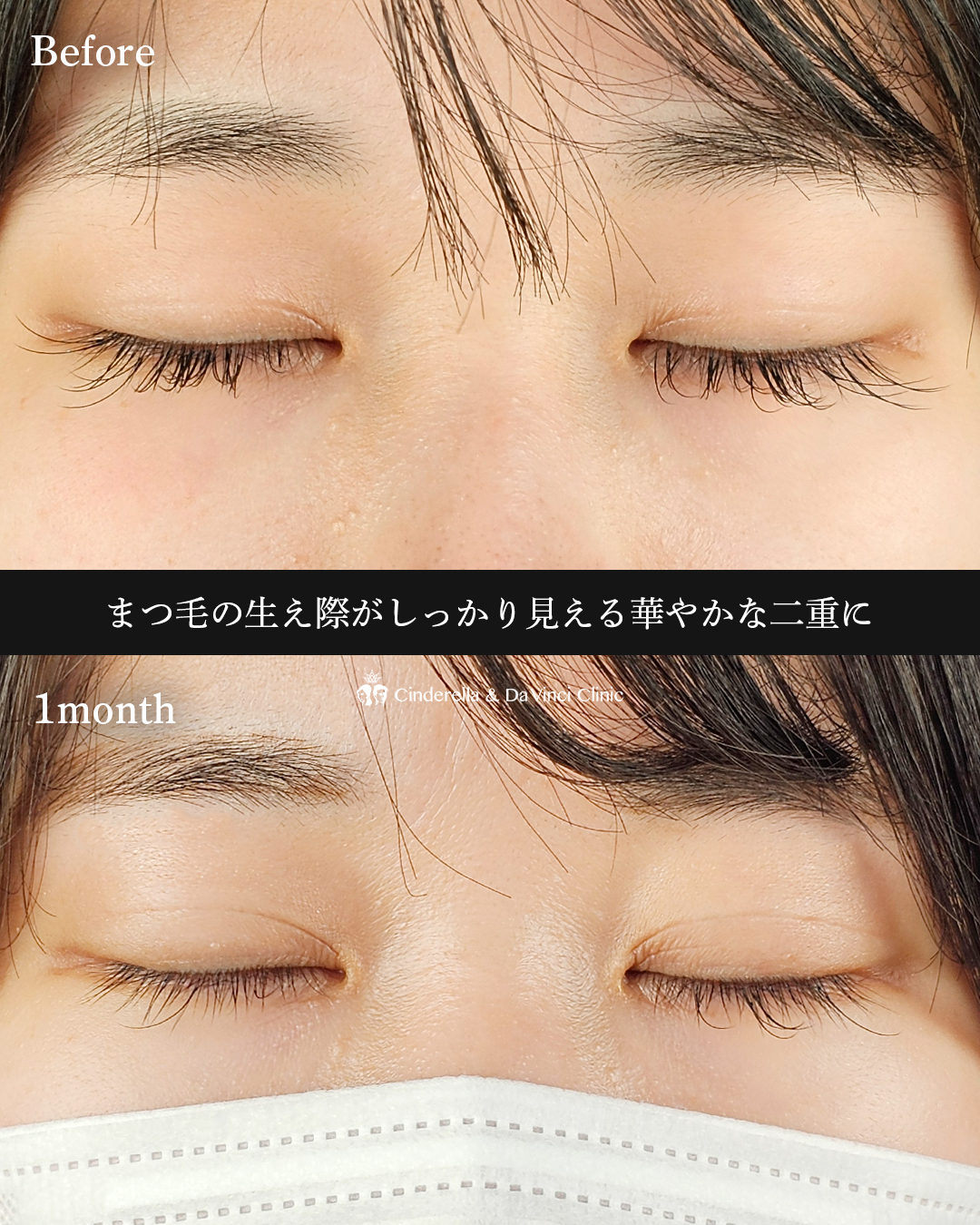 埋没で華やかな二重にの画像