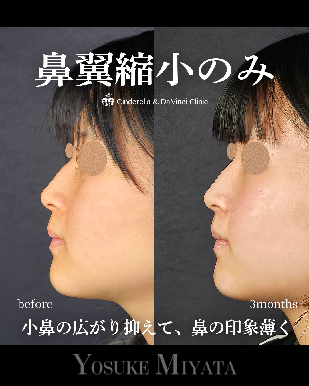 鼻翼縮小のみの画像