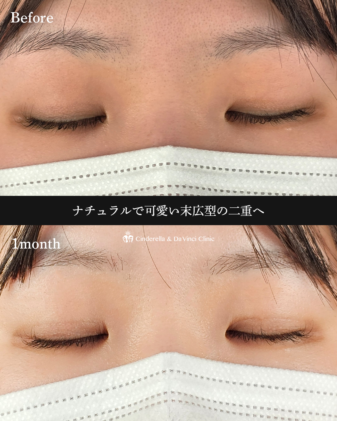 自然な末広二重にの画像