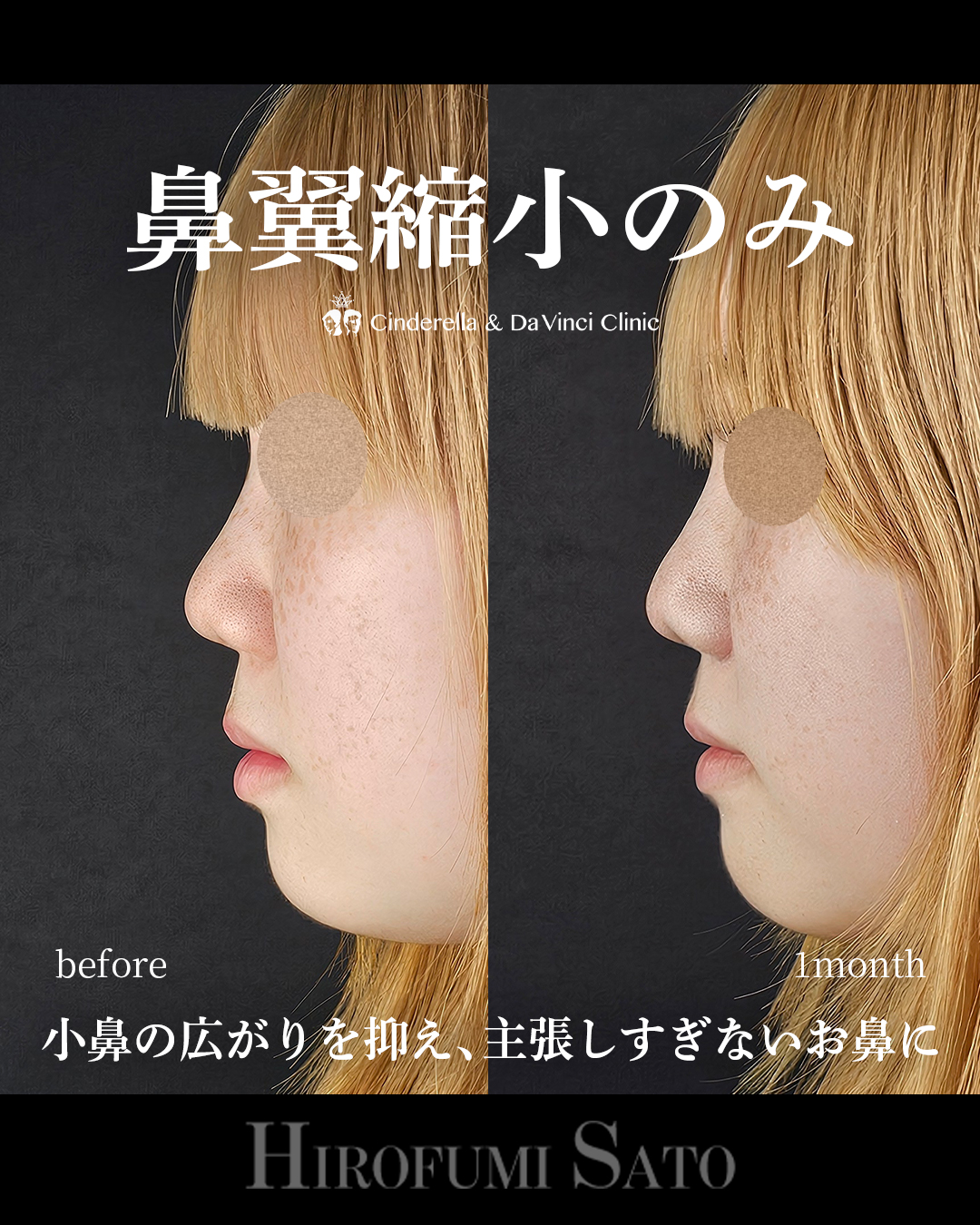 鼻翼縮小のみの画像