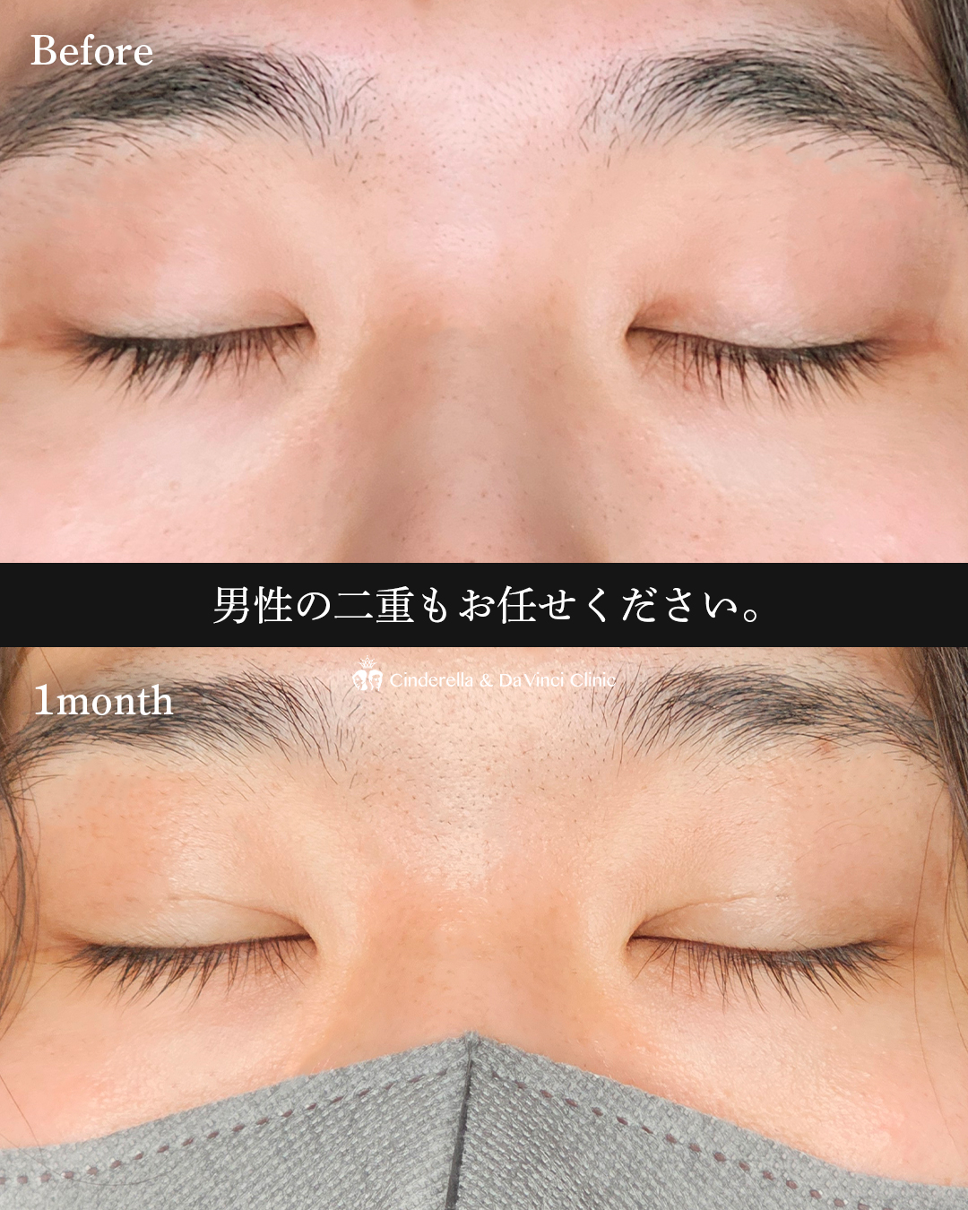 男性の自然な二重の画像