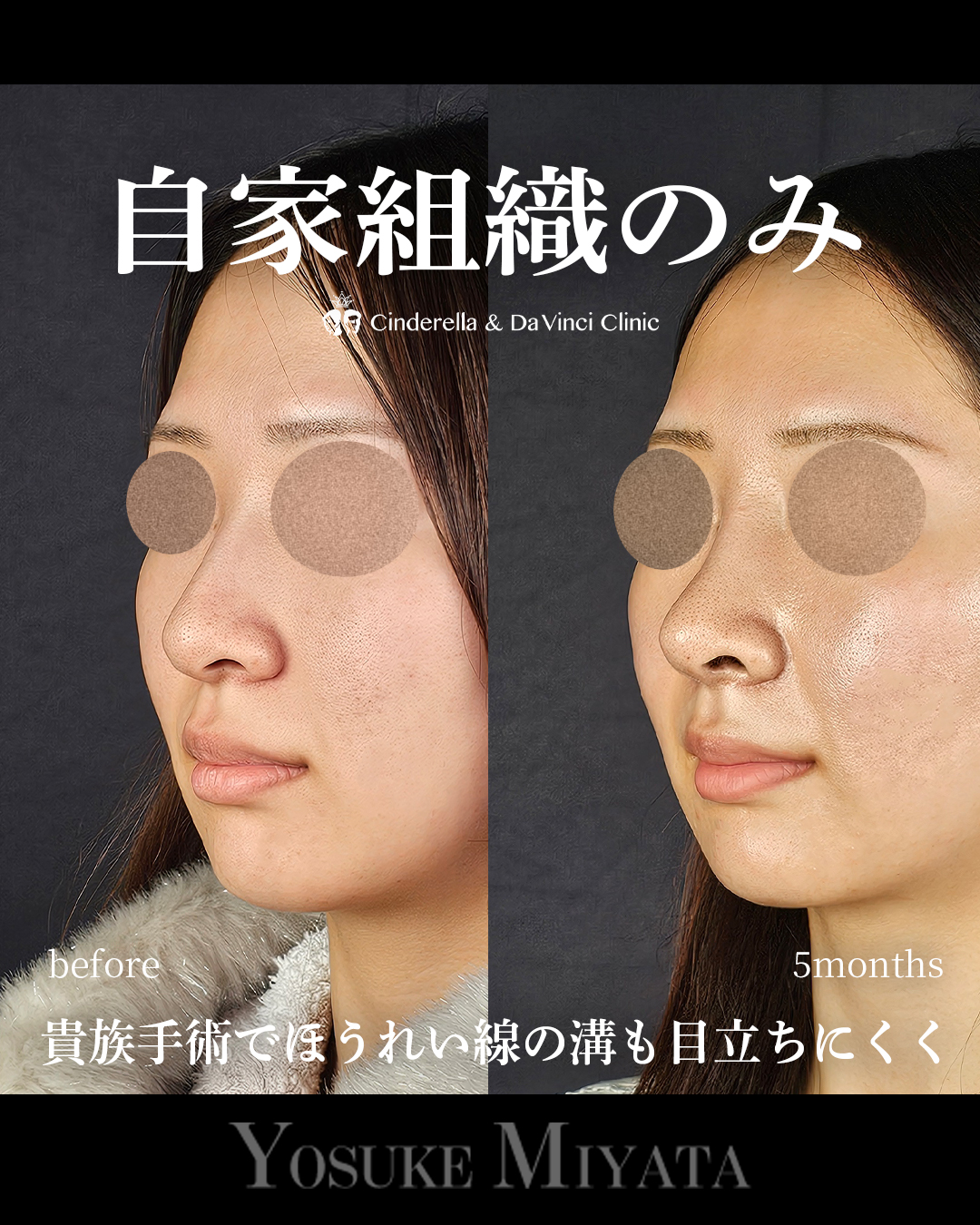 鼻先の丸みを軽減の画像