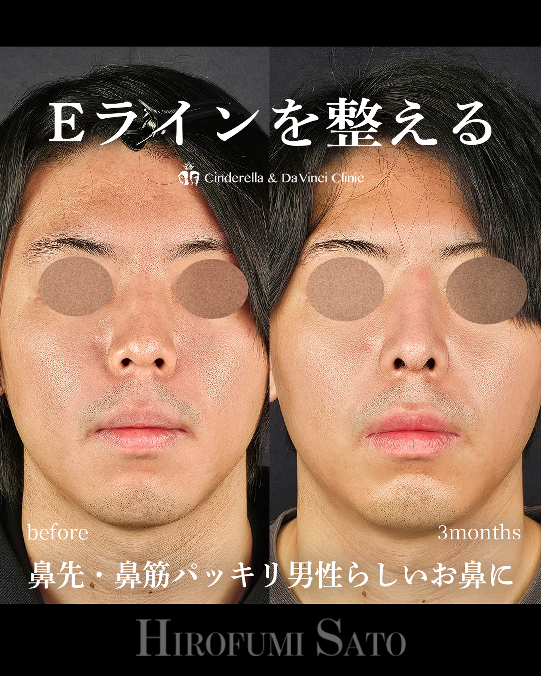 男性の鼻整形の画像