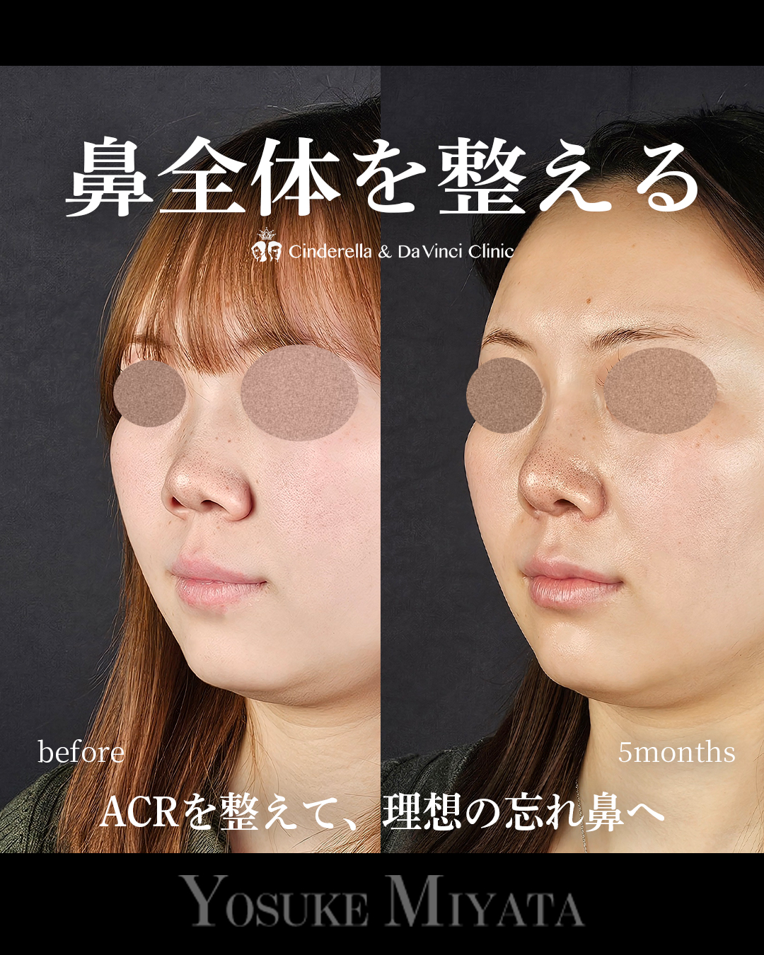 鼻全体を整えるの画像