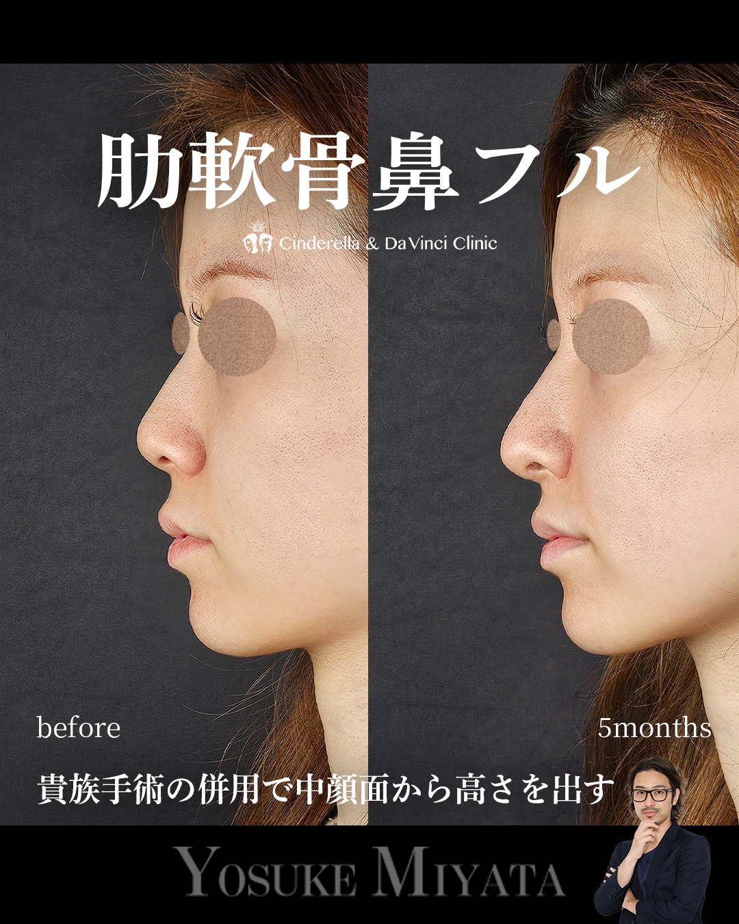 バランスの良い鼻の画像