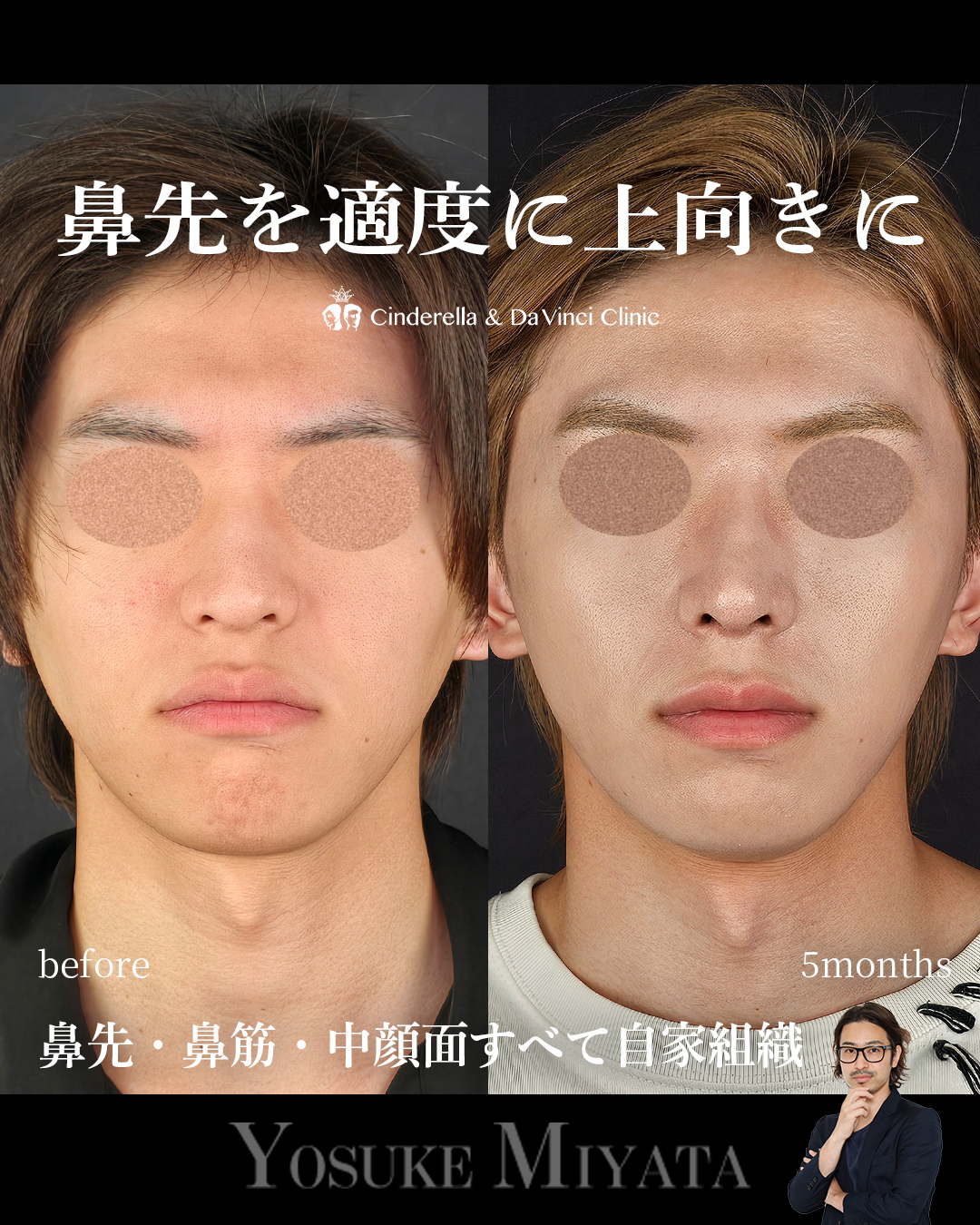 鼻先の角度を上にの画像