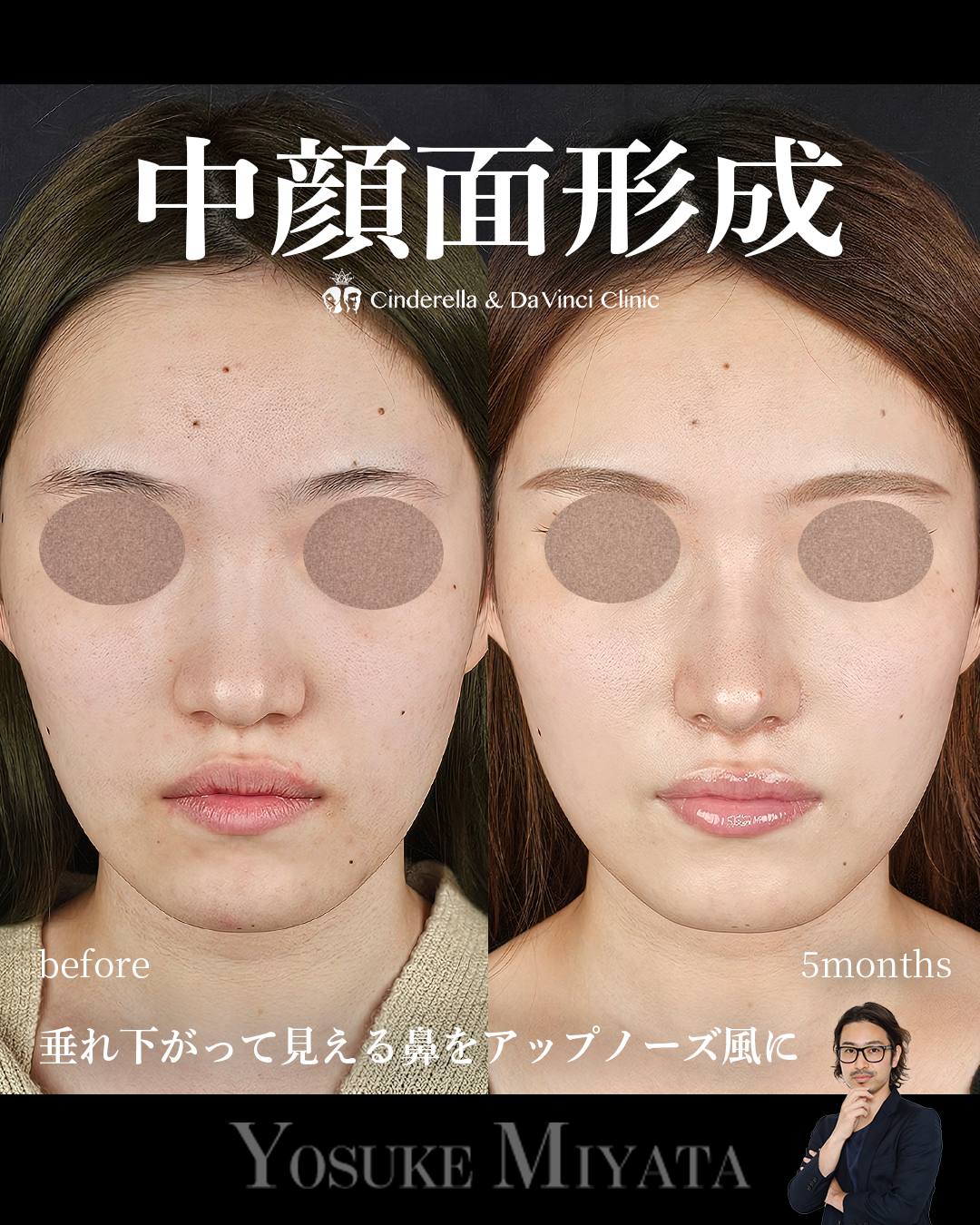 中顔面形成の画像