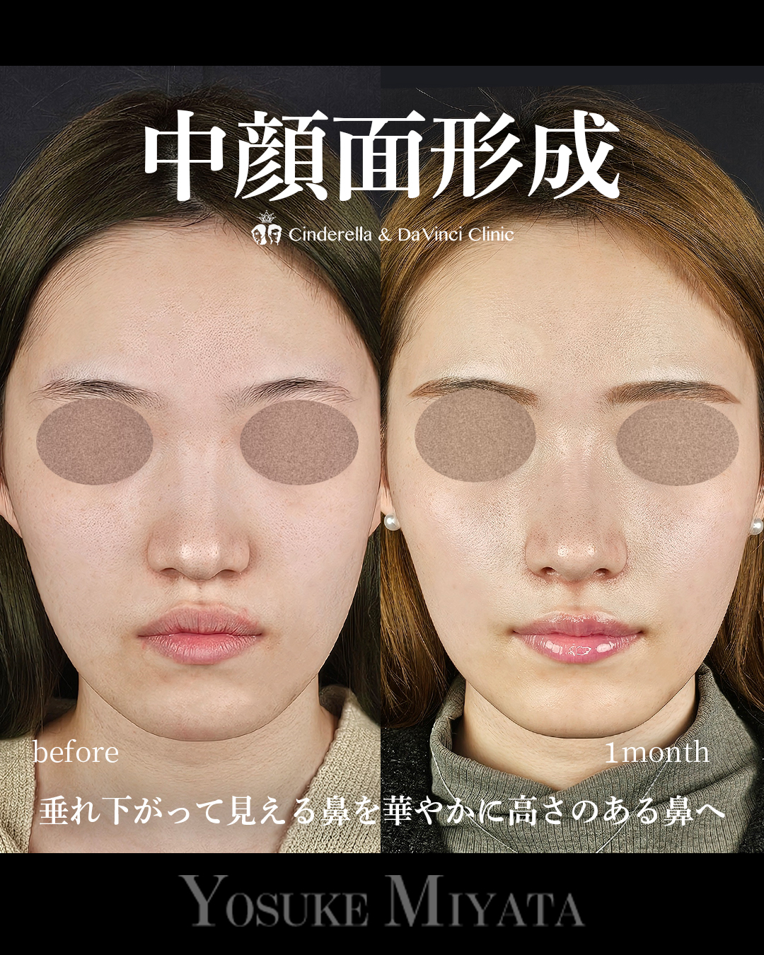 中顔面形成の画像