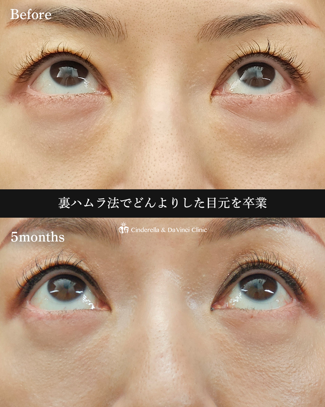 目の下若返りの画像