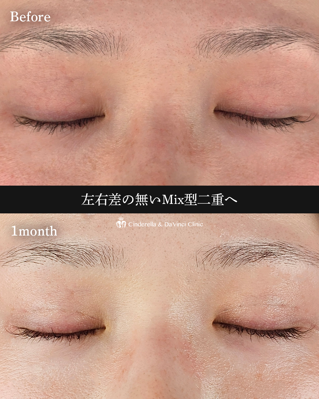 左右差の無い二重の画像