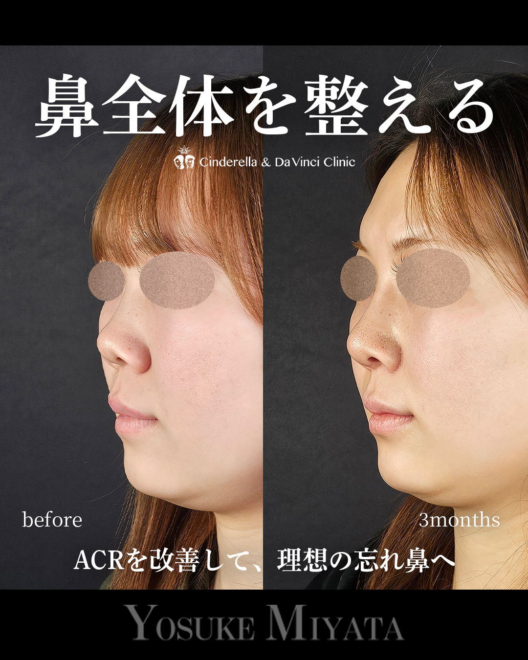 鼻全体を整えるの画像