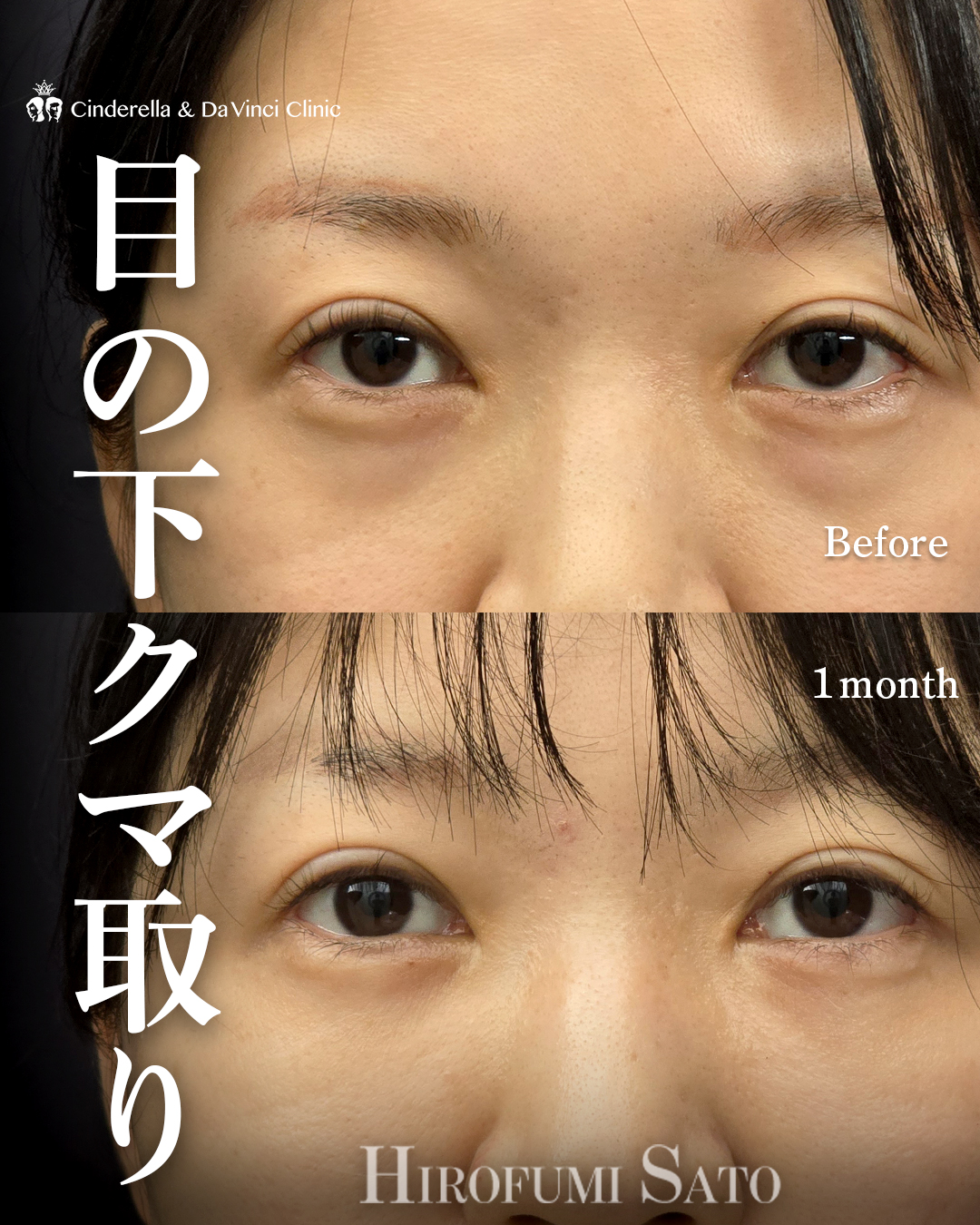 クマ取り(裏ハムラ法)