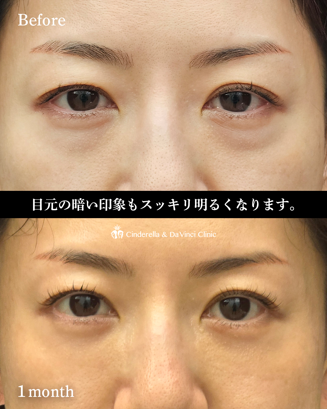 目の下若返りの画像