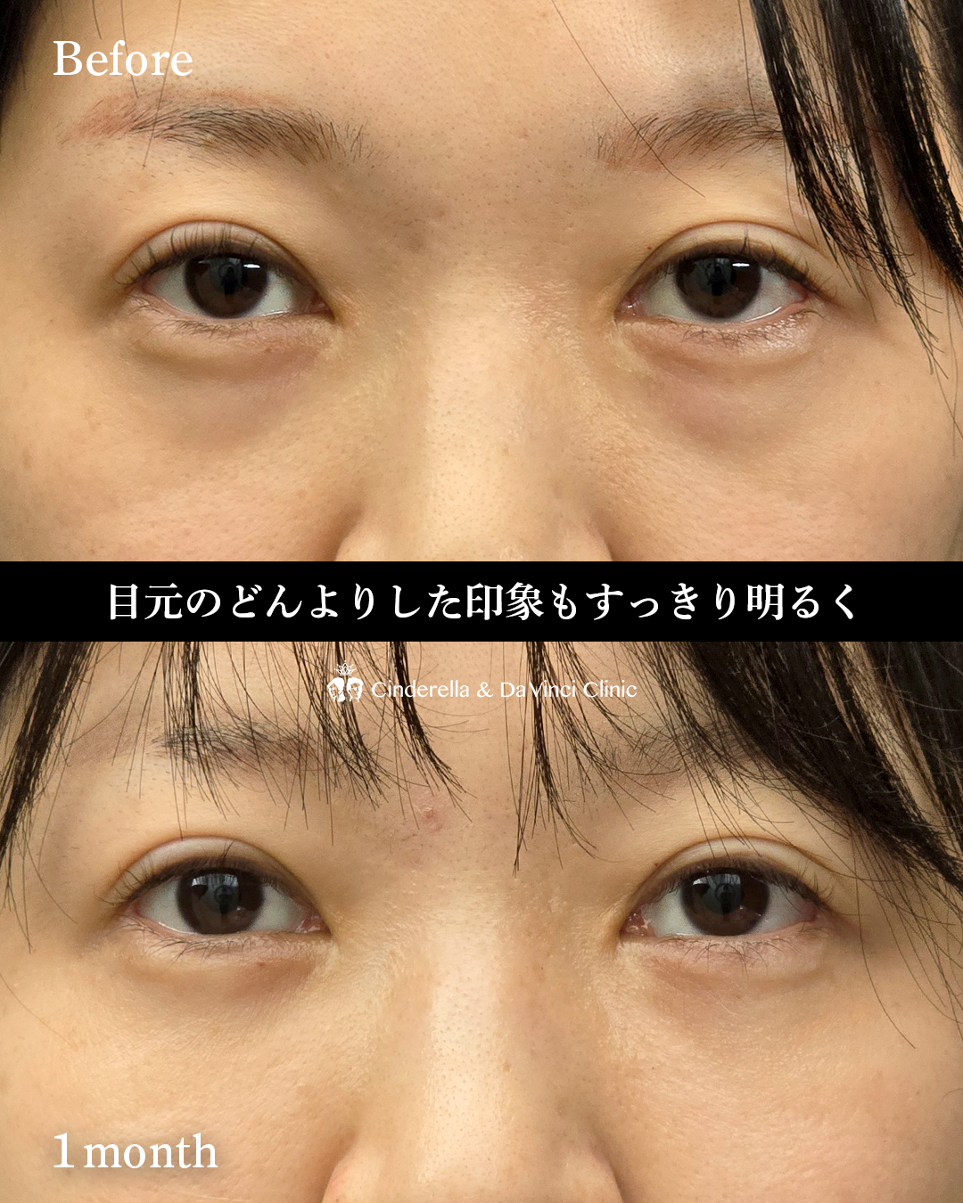 クマ取り(裏ハムラ法)の画像